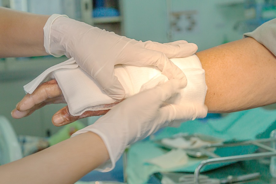 Person dressing burned hands with gauze